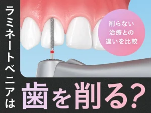 ラミネートベニアは歯を削る？削らない治療との違いを比較